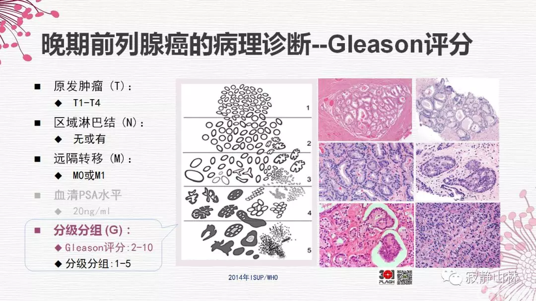 晚期前列腺癌的病理学诊断