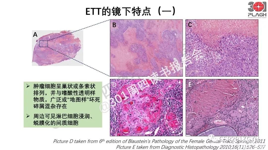 中间型滋养细胞肿瘤的诊断及鉴别诊断