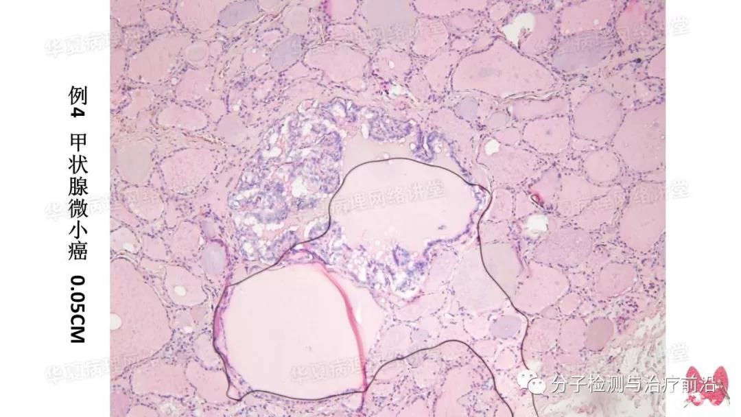 甲状腺疑难快速切片诊断