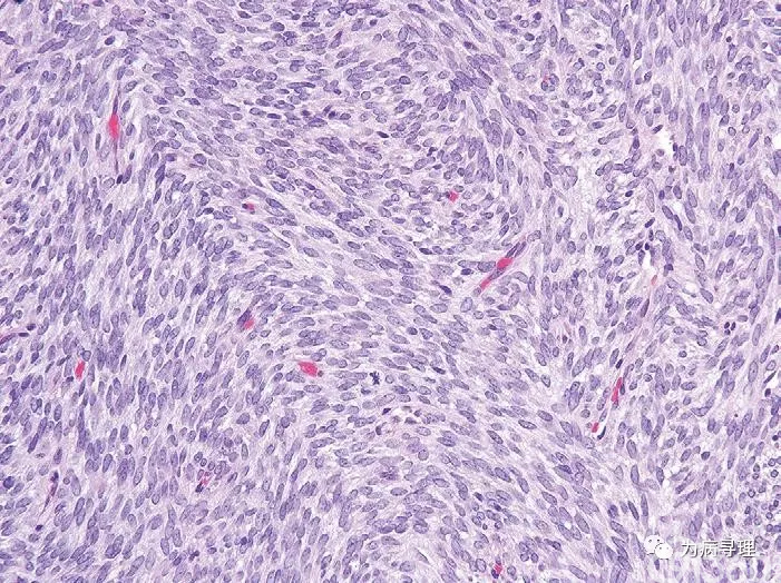 图5 单相滑膜肉瘤,肿瘤细胞呈交叉束状与鲱骨样(纤维肉瘤样)外观