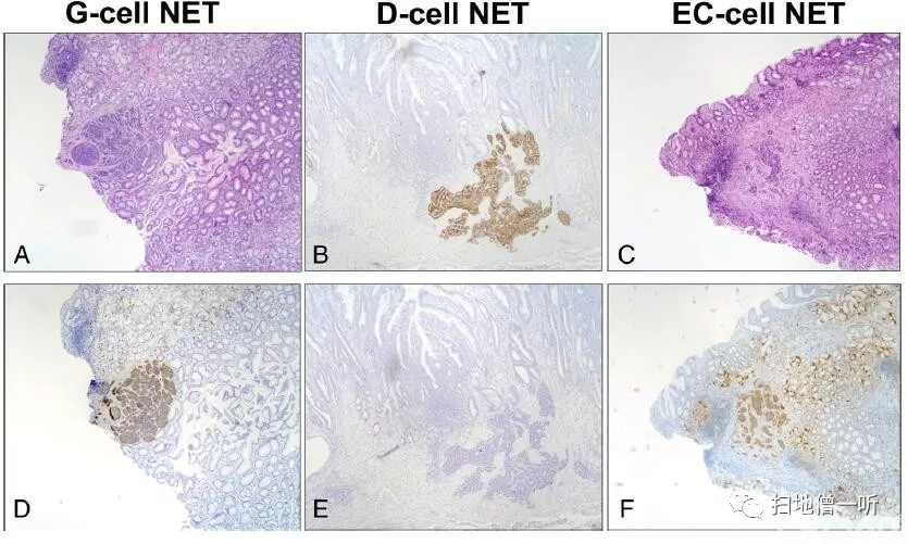 antral neuroendocrine tumour (nets)