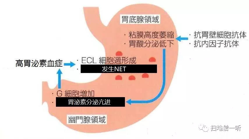 医学美图:胃神经内分泌肿瘤的前世今生