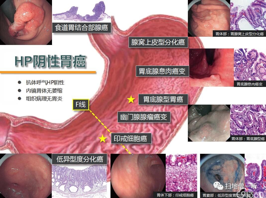 医学美图:hp阴性胃癌概述 - 91360智慧病理网