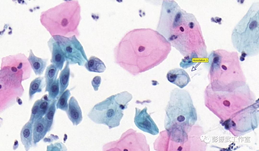 宫颈细胞学中的空泡陷阱
