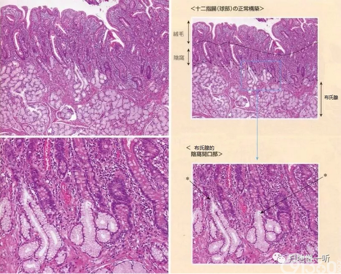 医学美图胃十二指肠上皮性粘膜内病变病理解读