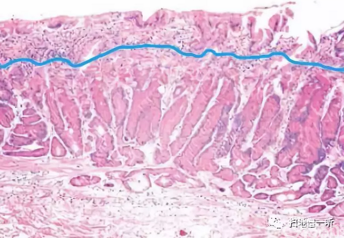 医学美图:胃·十二指肠上皮性粘膜内病变(病理解读)