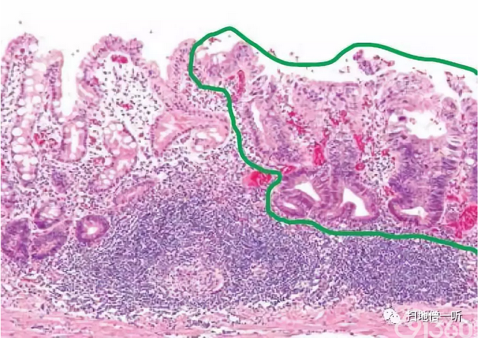 医学美图胃十二指肠上皮性粘膜内病变病理解读