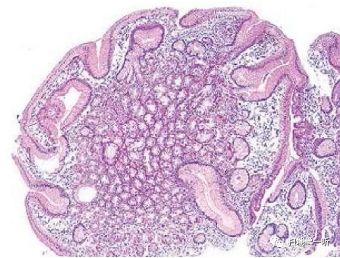 医学美图胃十二指肠上皮性粘膜内病变病理解读