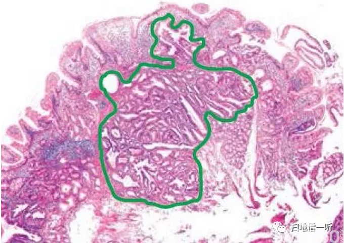 虽然在本例中没有暴露在表面,但是一旦露出,胃小凹上皮型肿瘤细胞就会