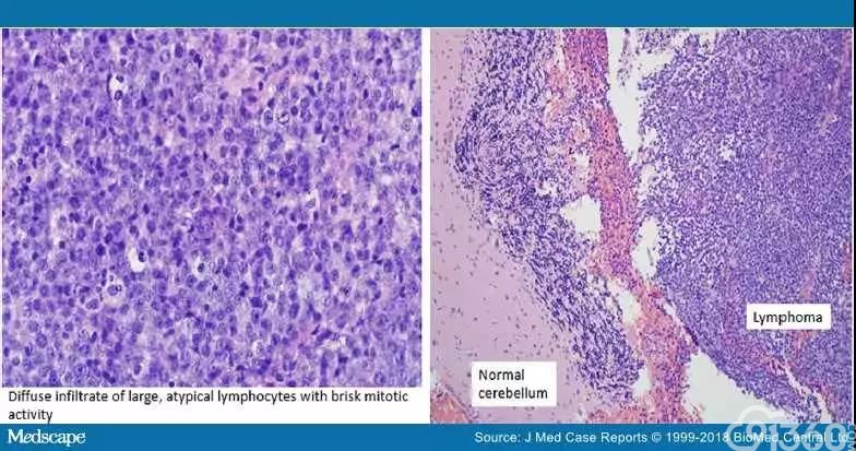 组织病理切片显示大型非典型淋巴细胞弥漫性浸润,小脑病变的丝