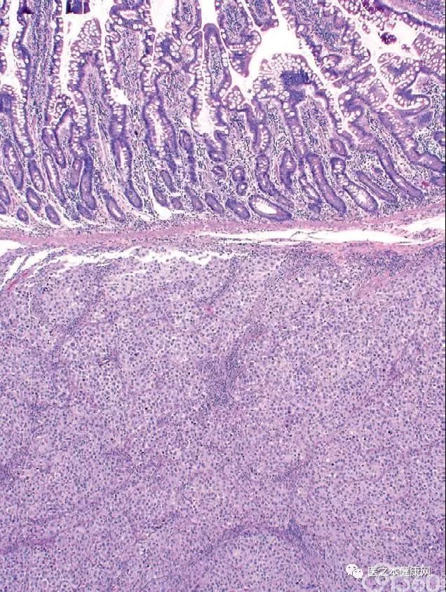 图4. 恶性黑色素瘤转移至小肠