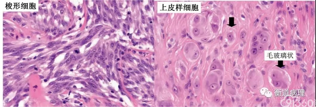 病理之家 黑素细胞肿瘤的诊断(上)    ·由上皮样细胞或梭形