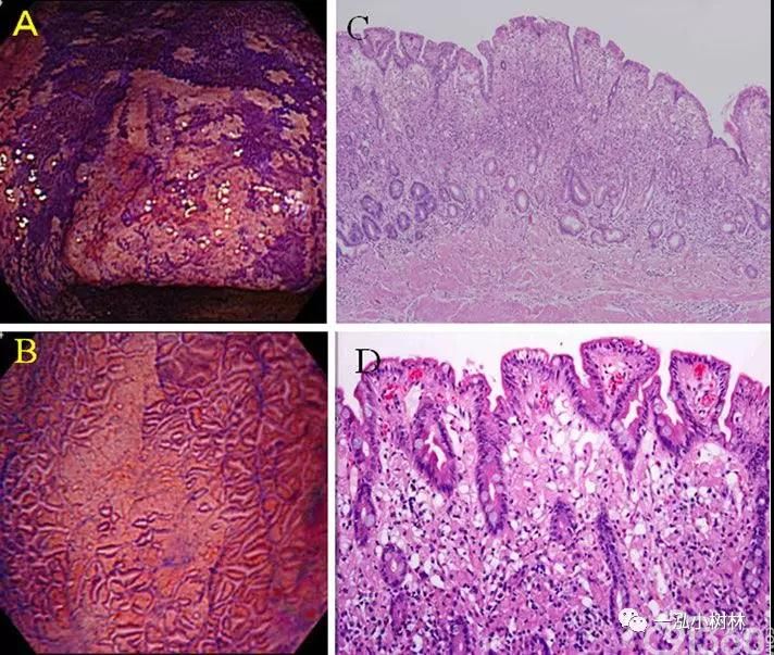 早期胃癌和胃腺瘤的放大色素内镜表现 91360智慧病理网