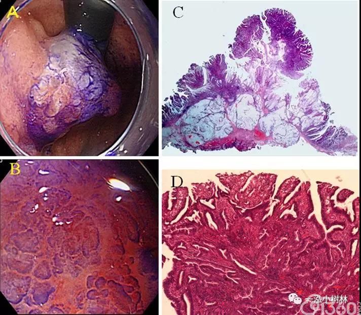 早期胃癌和胃腺瘤的放大色素内镜表现