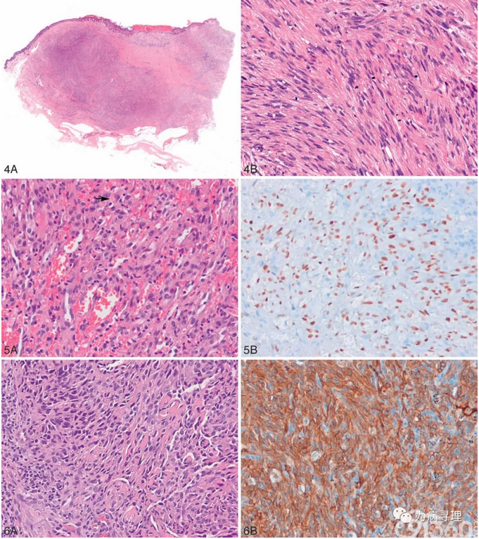 浅谈皮肤梭形细胞肿瘤的病理诊断