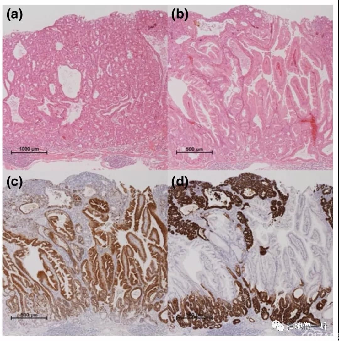 医学美图胃腺瘤相关病理研究