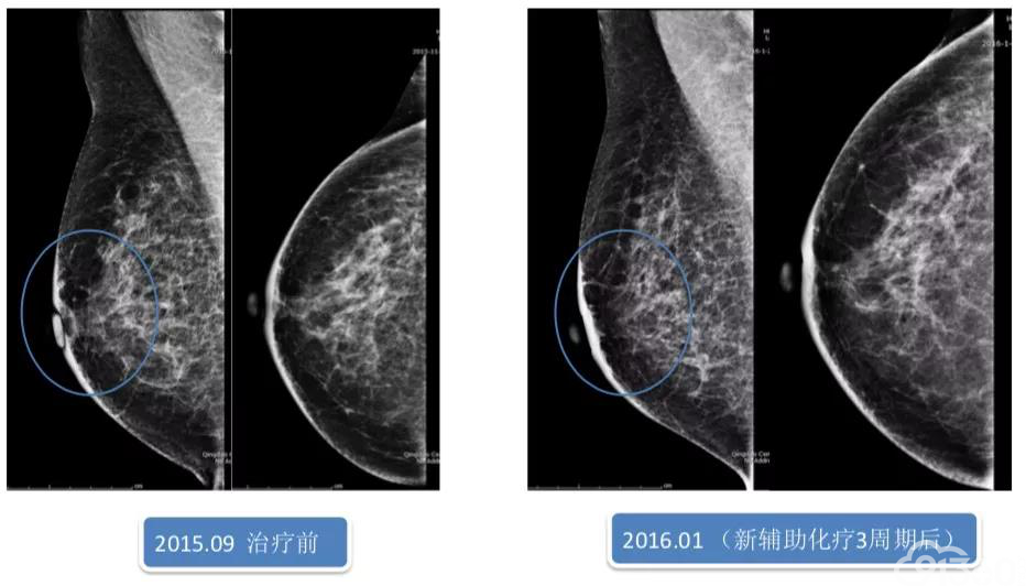 美例秀秀|论her2阳性型炎性乳腺癌持续抗her2的重要性