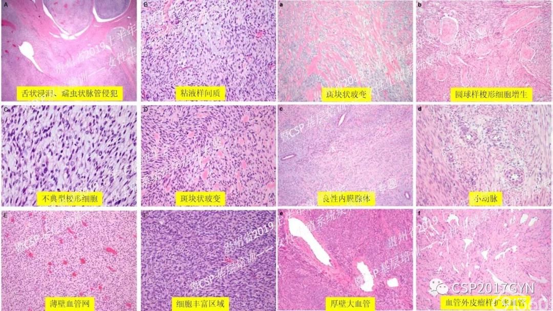 中华病理学会基层培训遵义站讲座六子宫内膜间质肿瘤的病理诊断及鉴别