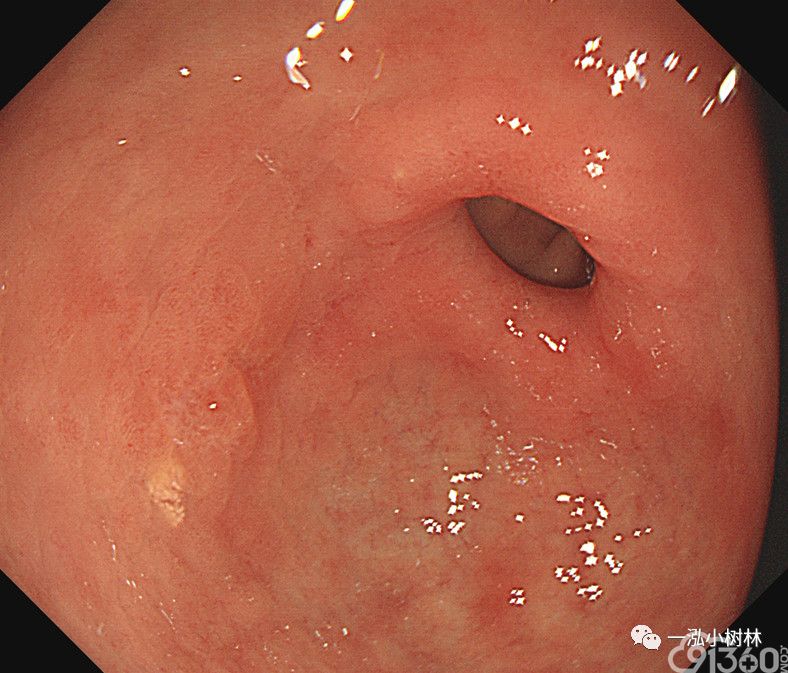 早期胃癌内镜诊断详解篇(2)