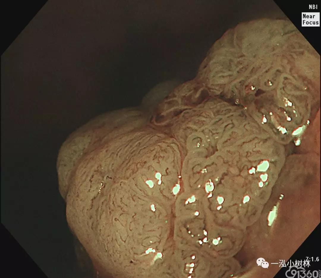 nbi me iv型腺管靛胭脂白光绒毛腺瘤占整个大肠腺瘤的1.3~5.