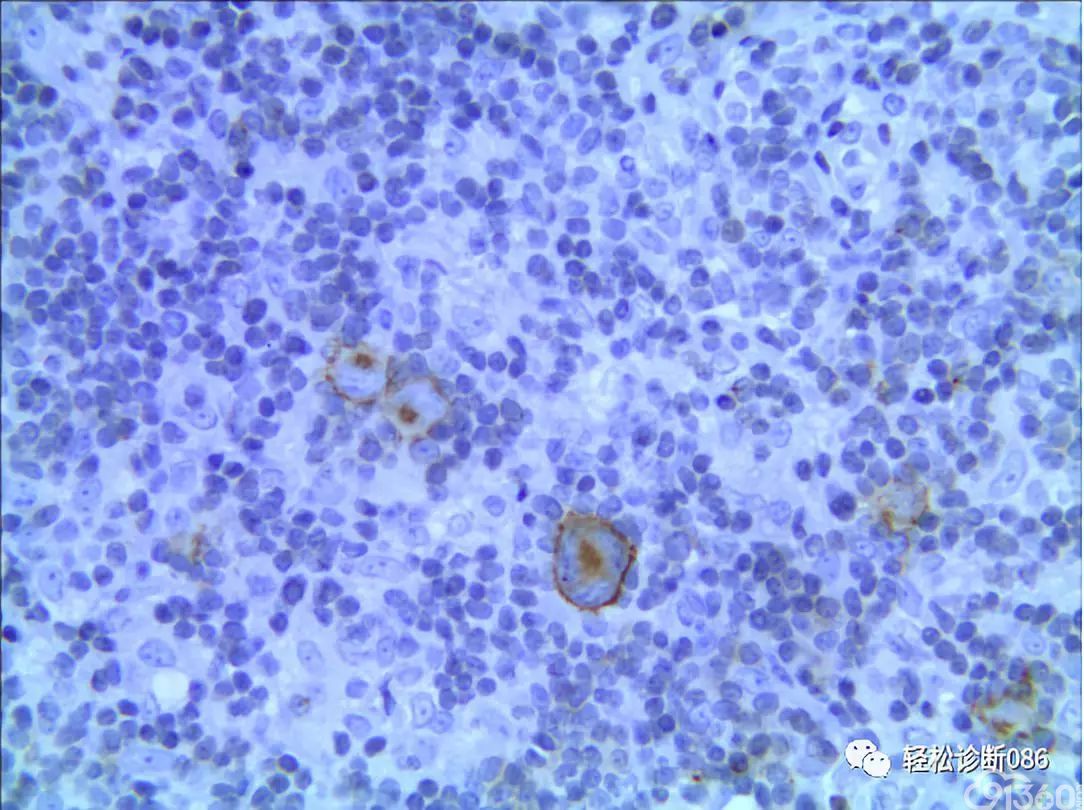 图示rs样大细胞cd30阳性.细胞膜及高尔基区着色.