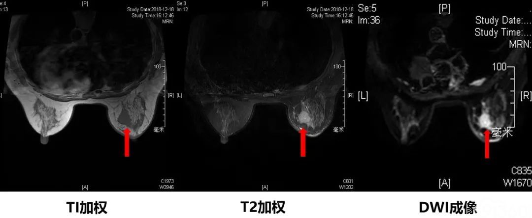 美例秀秀曲妥方舟her2阳性乳腺癌的新希望