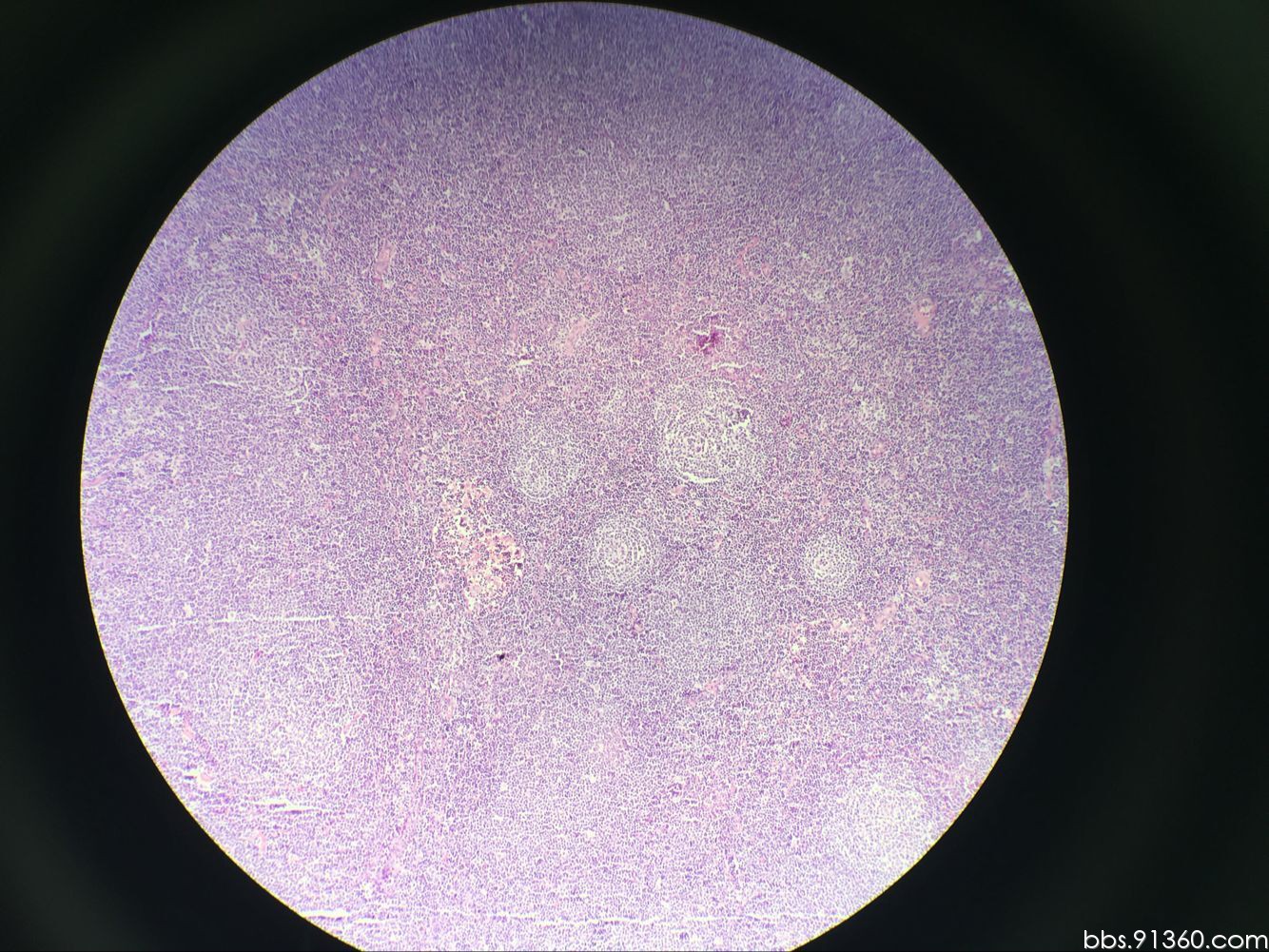 男55岁,双颌下肿大淋巴结