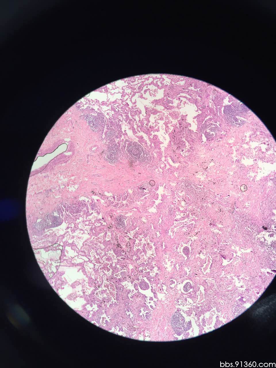 慢性炎症伴肺泡上皮反应性增生?