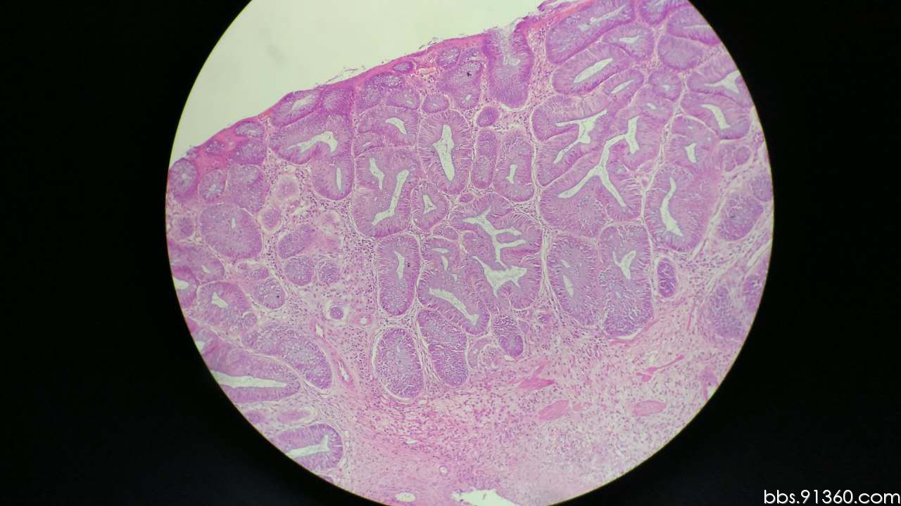 结肠息肉 管状绒毛状腺瘤伴高级别上皮内瘤变讨论病例【ibd病理群病例