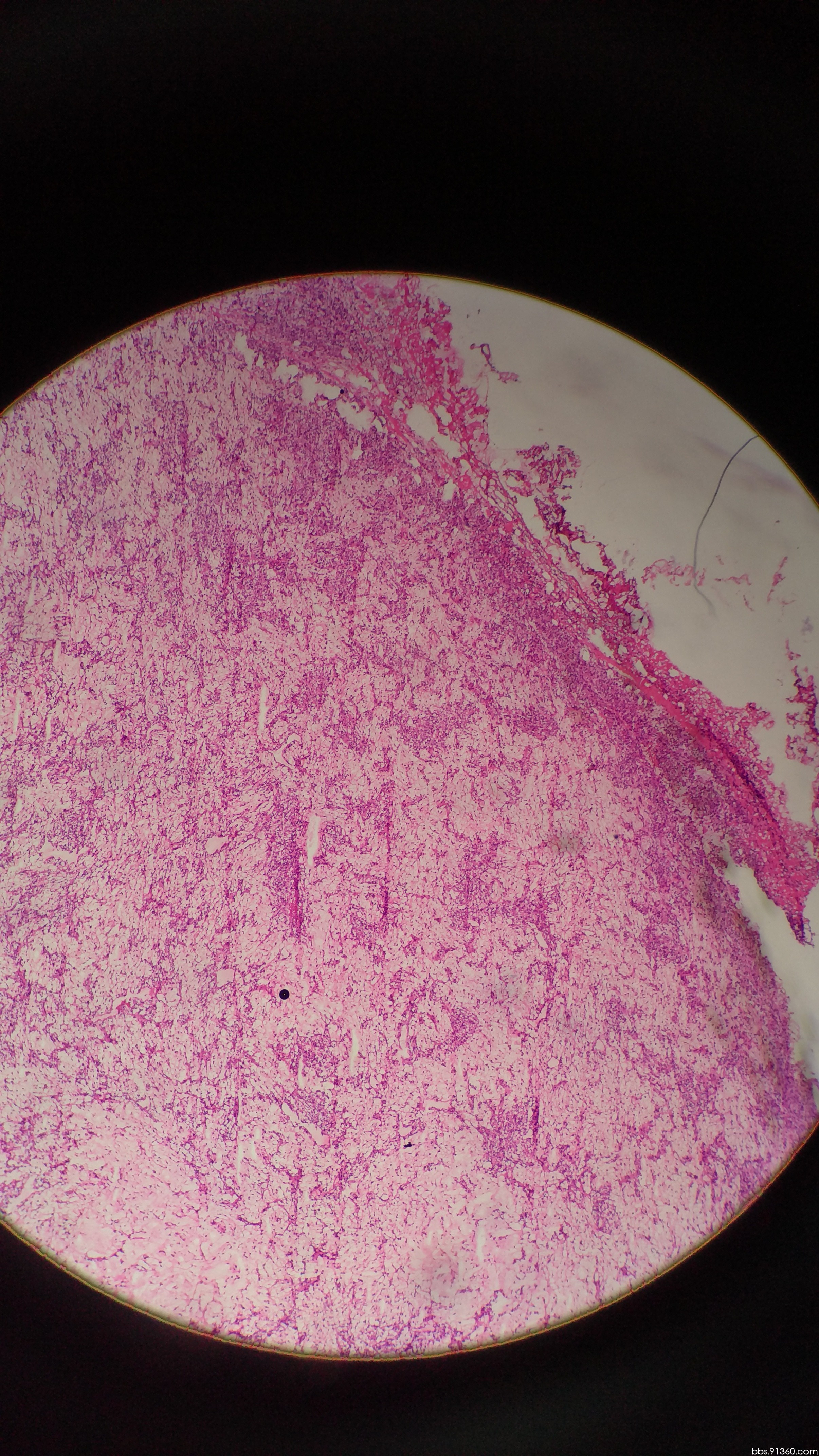 乳腺冰冻特殊类型的浸润癌?讨论2017.06.