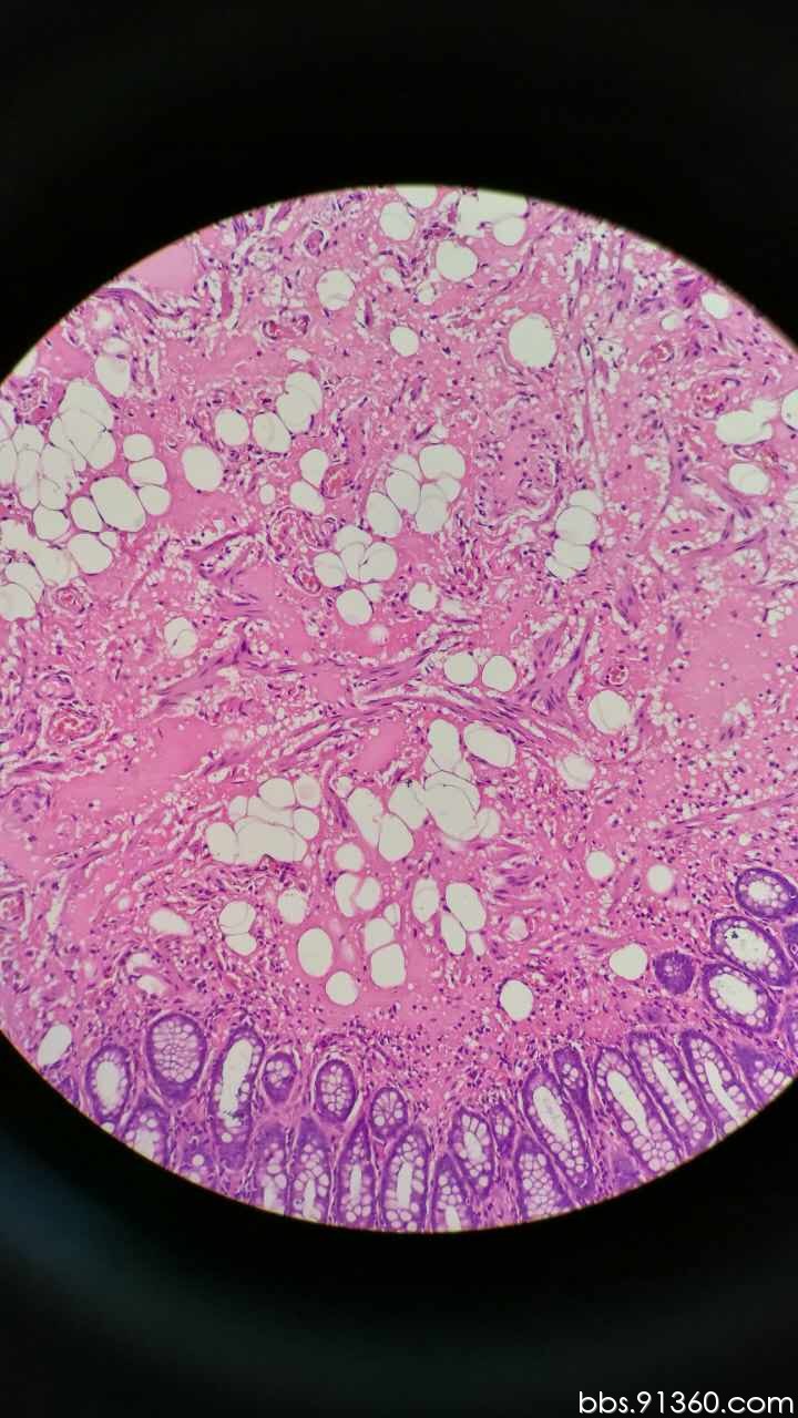 直肠息肉活检 错构瘤样息肉【ibd病理群病例31】