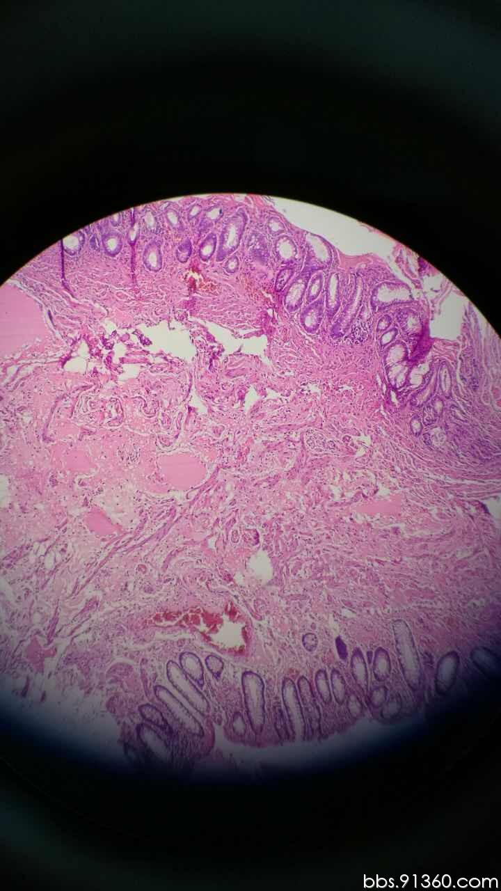 直肠息肉活检 错构瘤样息肉【ibd病理群病例31】