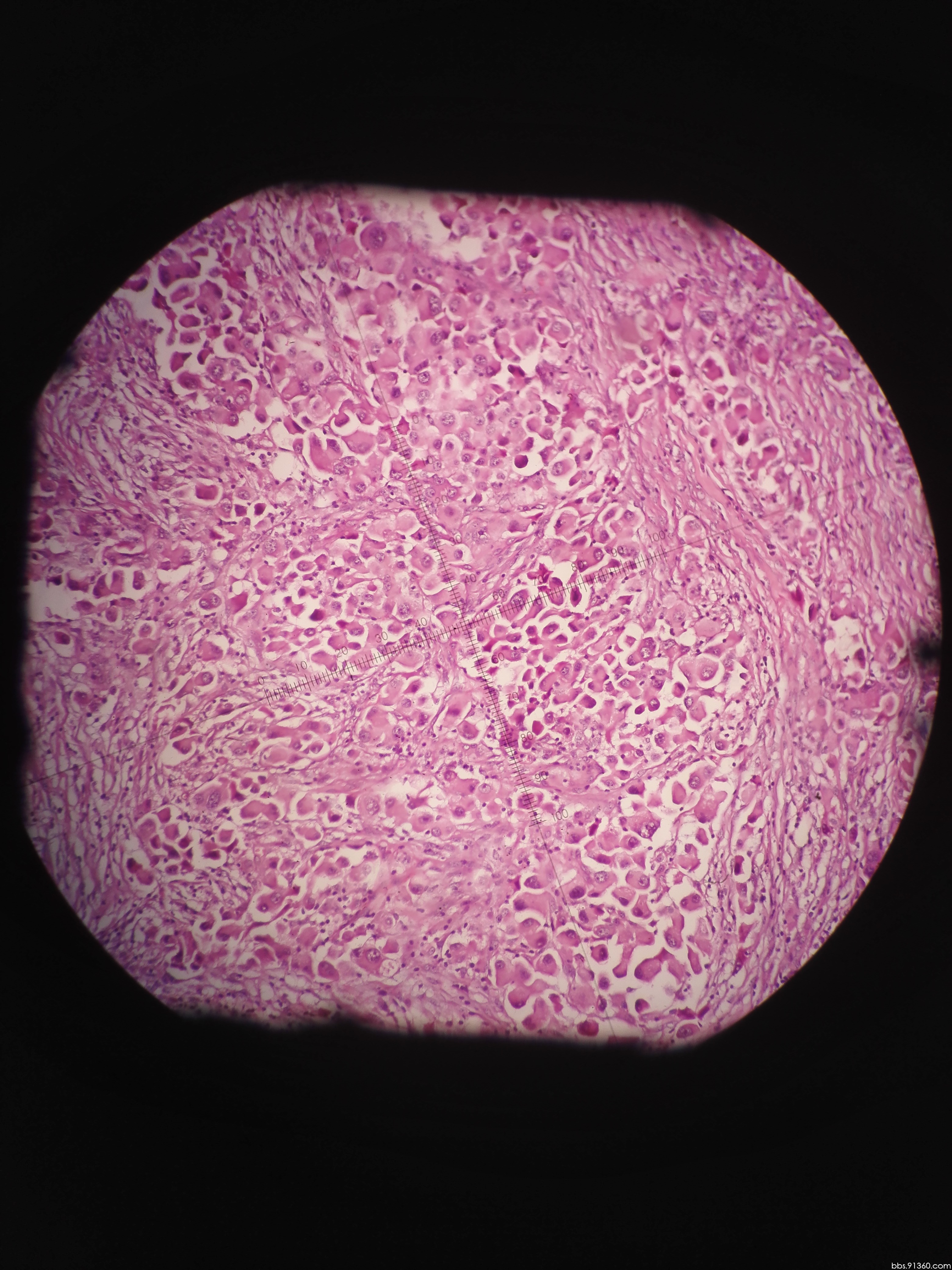 转移性低分化腺癌讨论病例【胸部等器官疾病诊断论坛病例160】