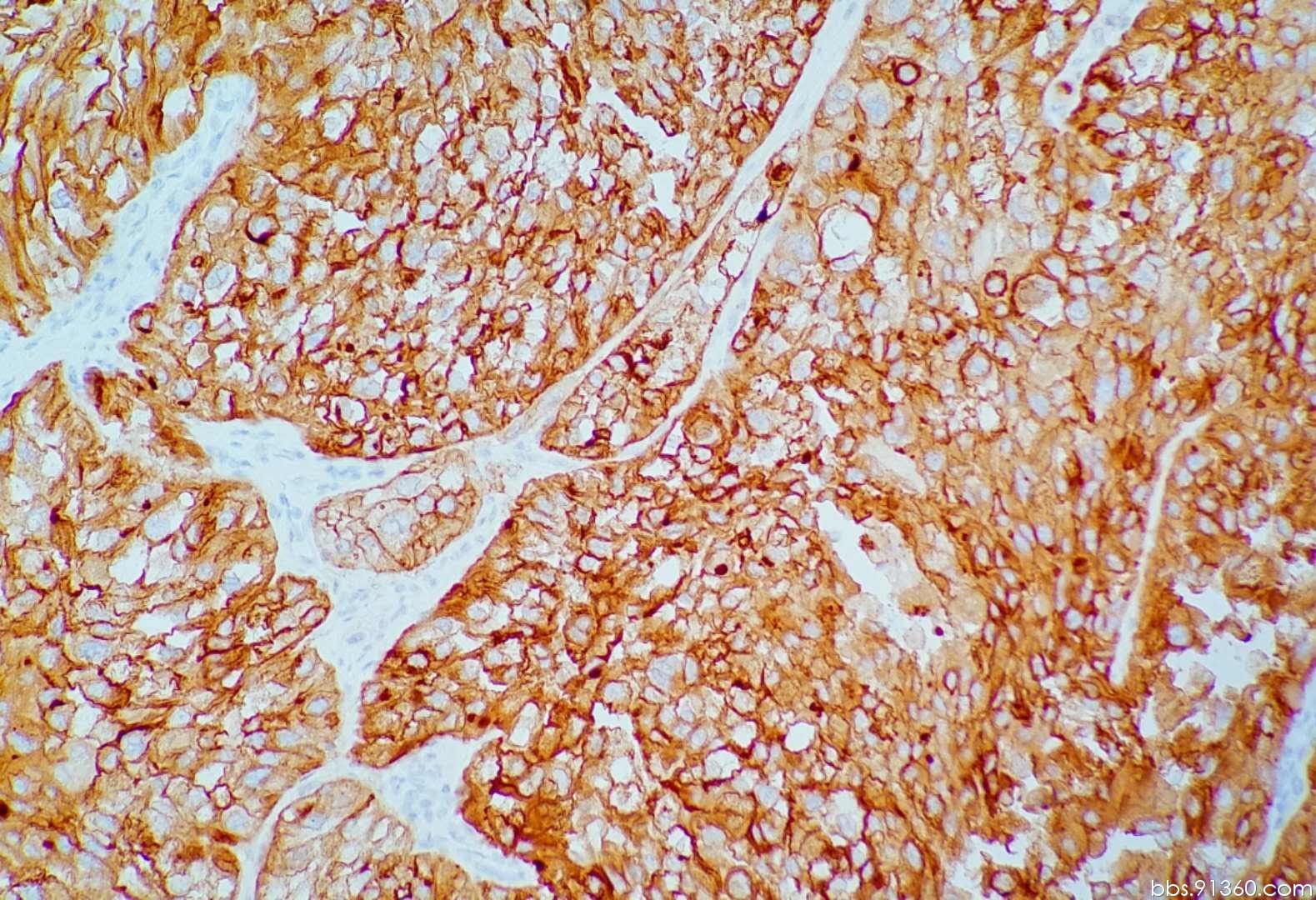 肾透明细胞癌肿瘤图片图片