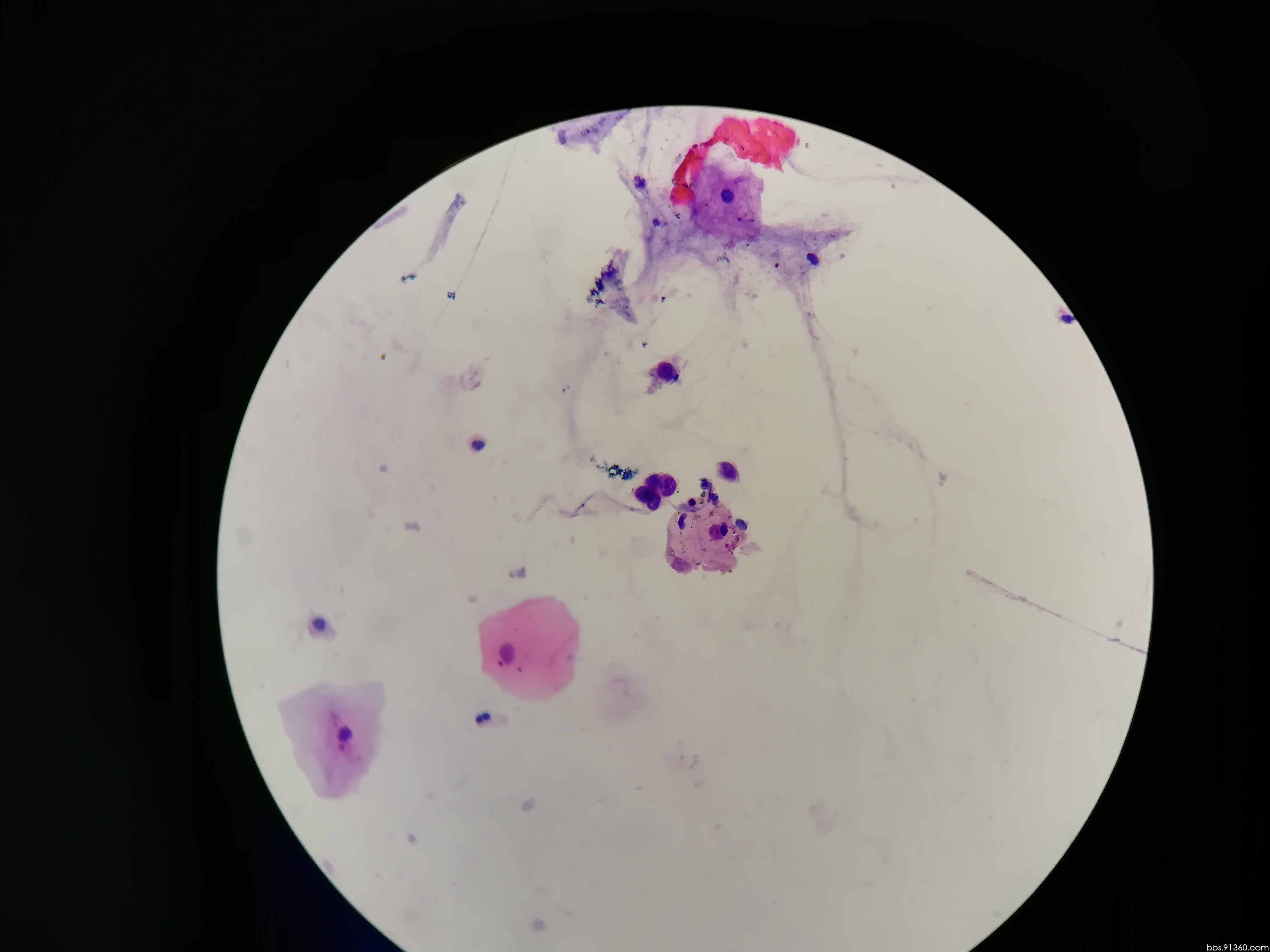 痰标本 腺癌讨论病例【中美加非妇科细胞学交流群病例86】