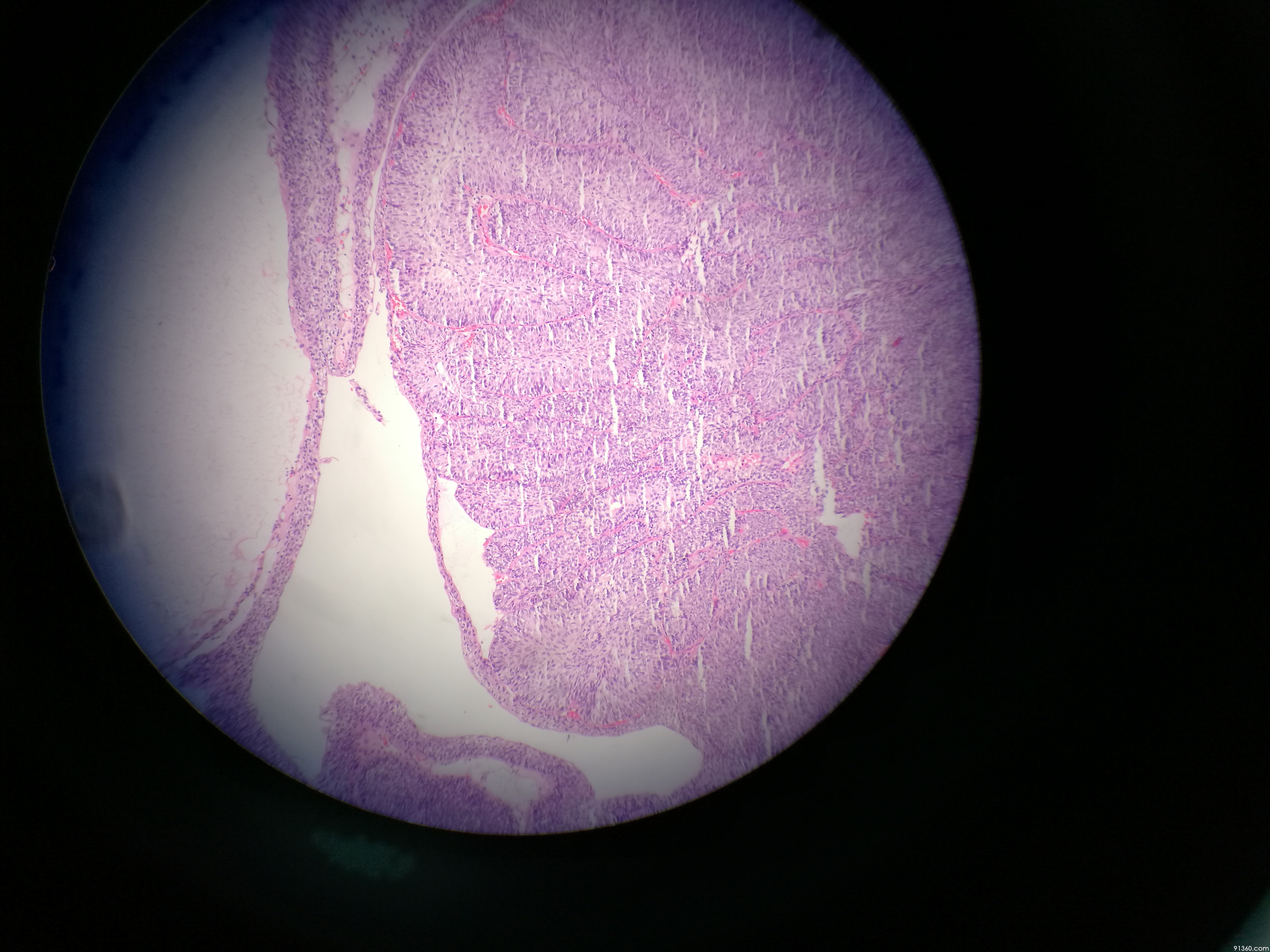 膀胱肿物 非浸润性内翻性乳头状尿路上皮癌(低级别)讨论病例【中华