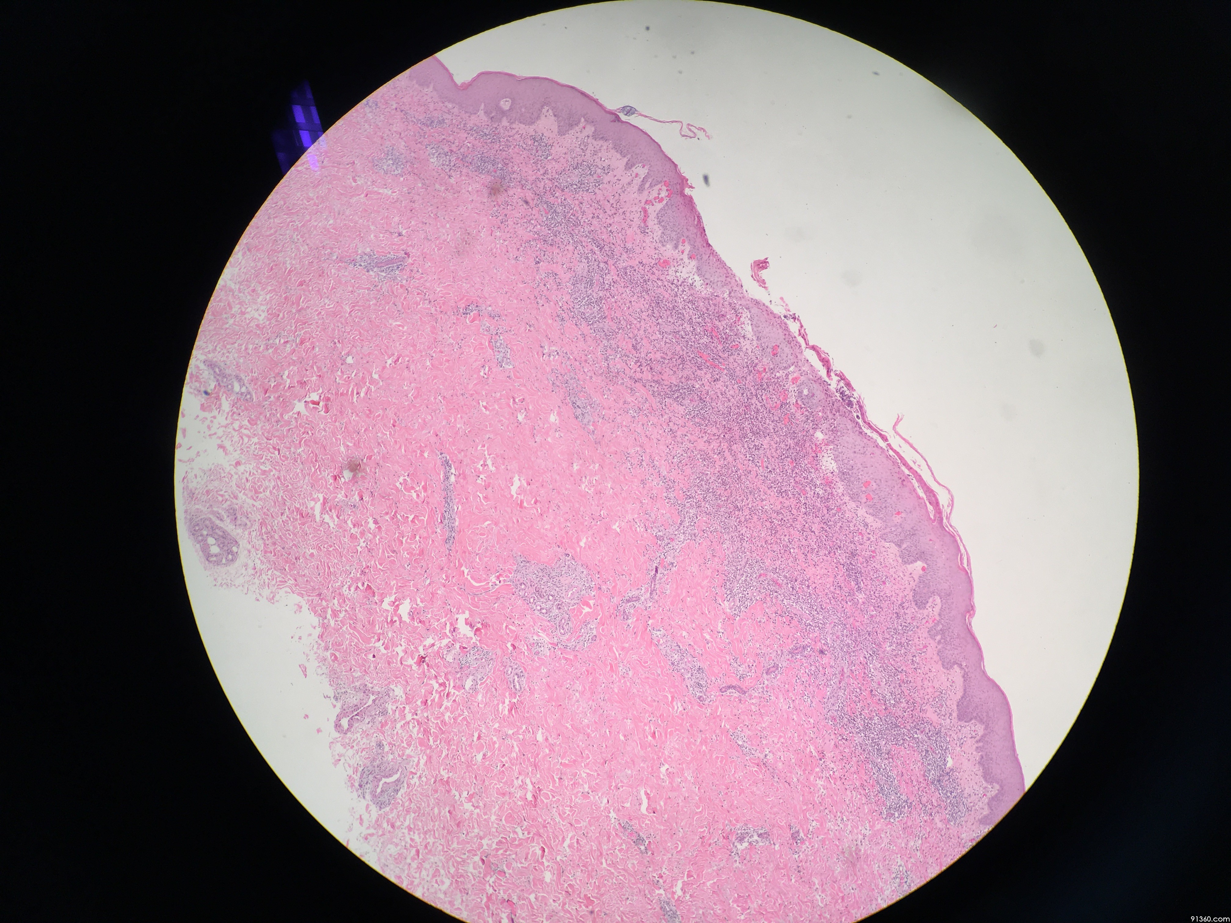 腰部皮肤溃疡活检