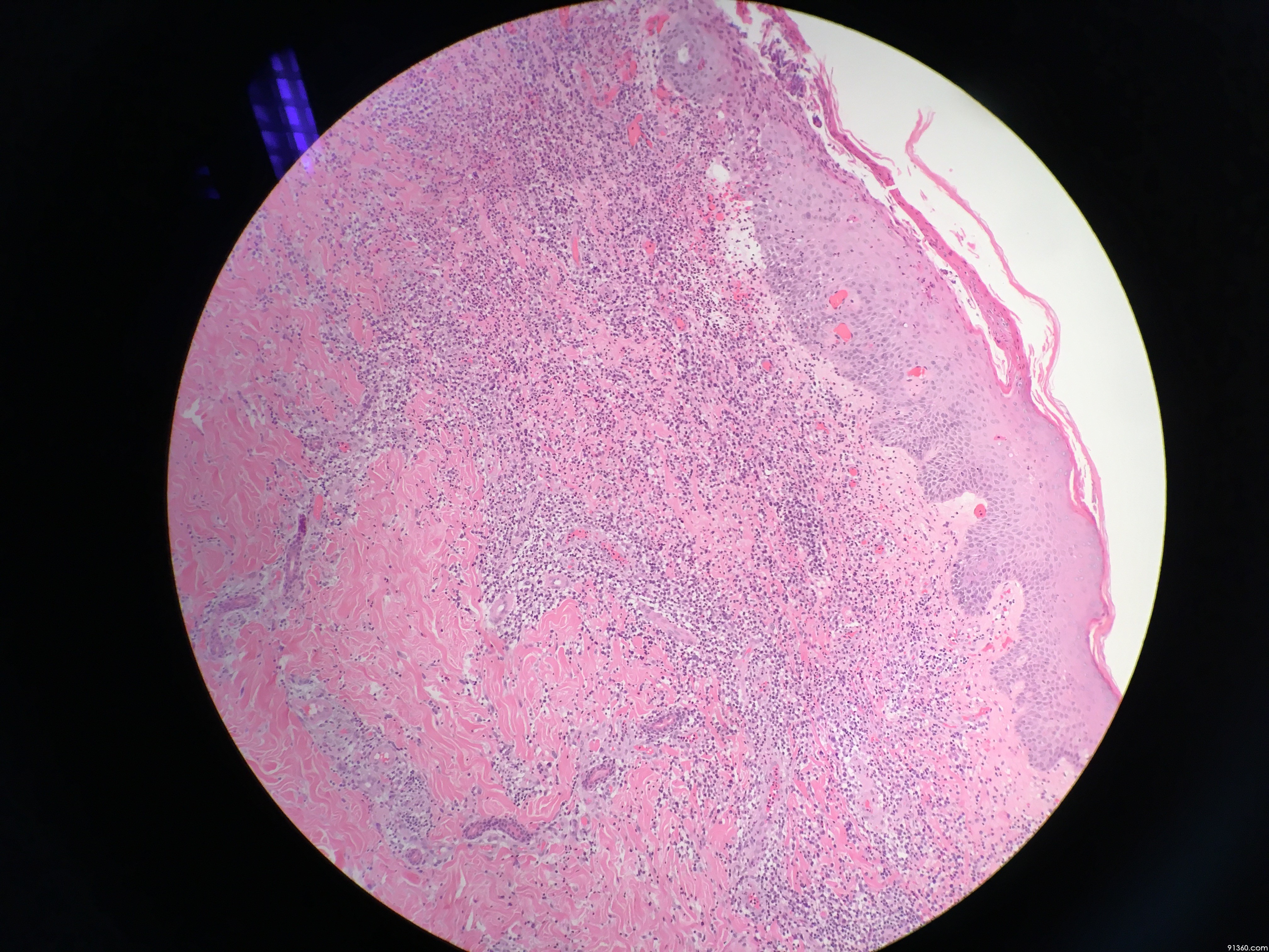 腰部皮肤溃疡活检