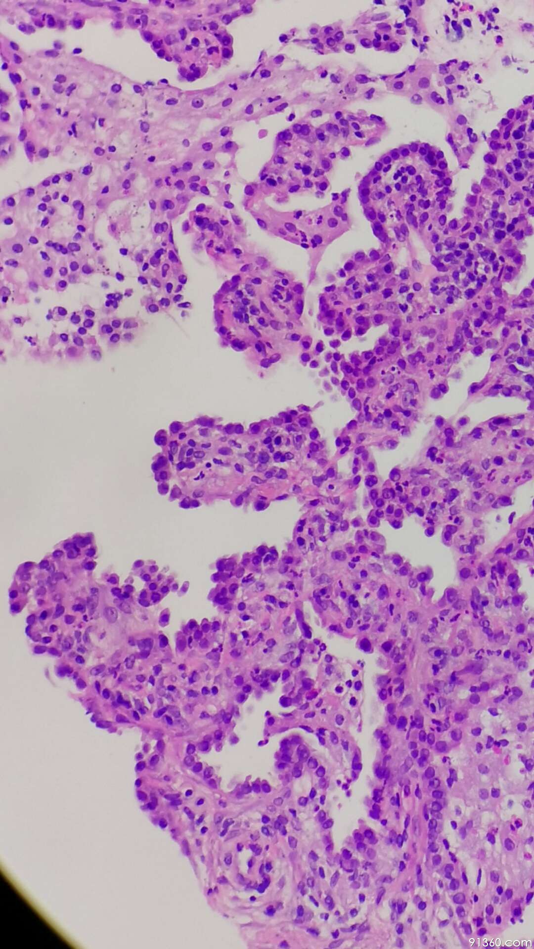 一附院病理科李晟磊考虑肺上皮肿瘤性病变,乳头状区p63是否有阳性细胞