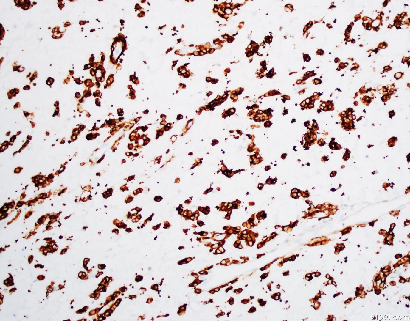 一般胞浆都是空的;另外总是可以看到spindle cell component   ring