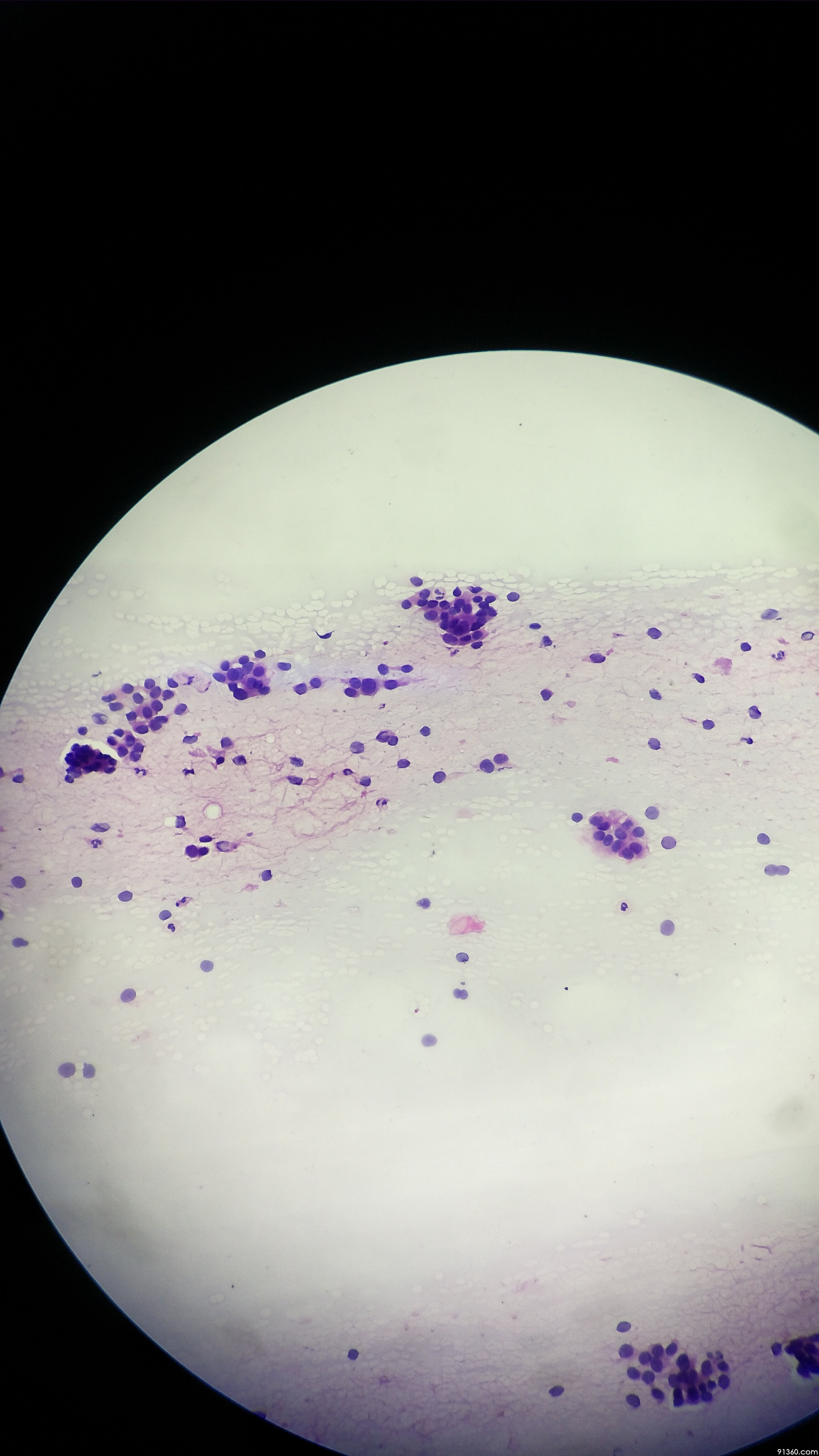 细针穿刺 倾向腮腺肿瘤讨论病例【中美加非妇科细胞学