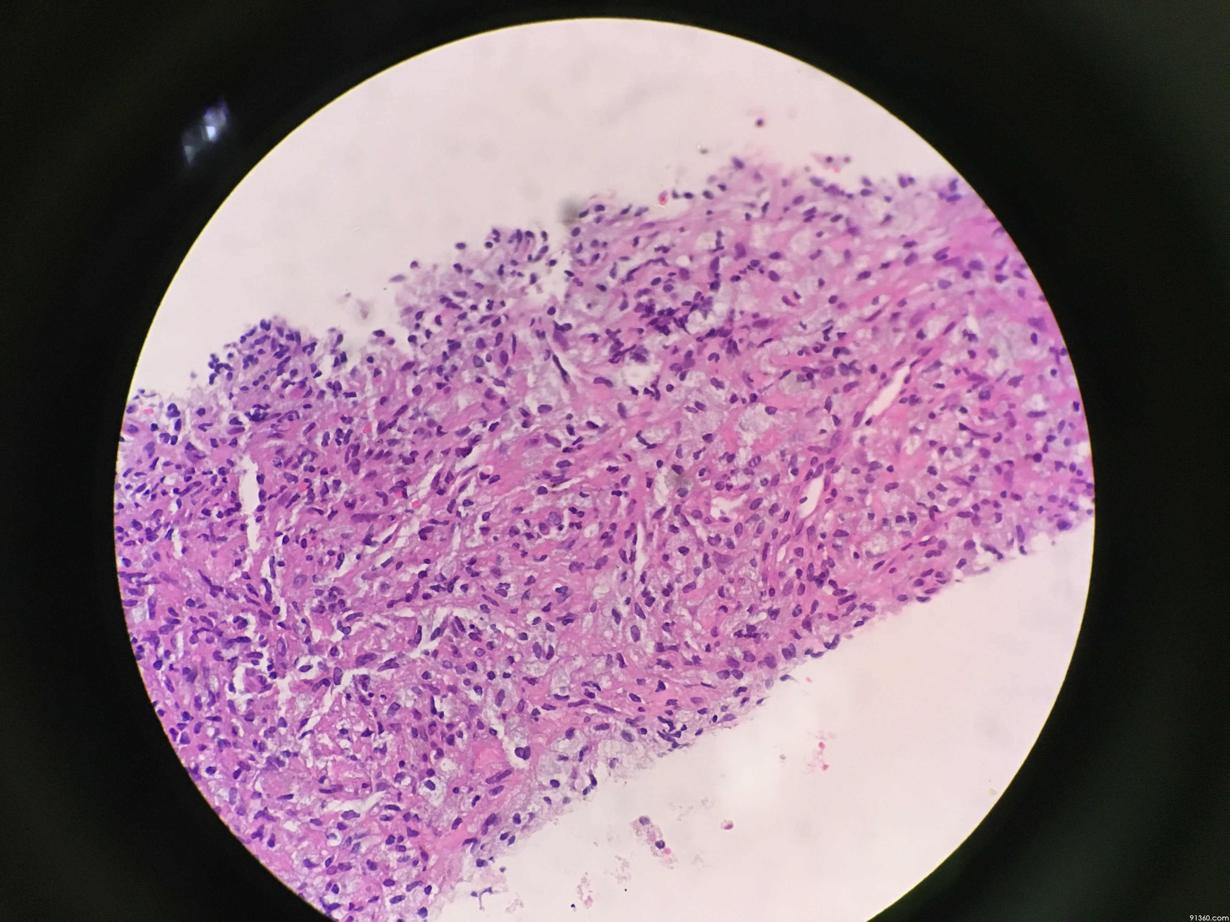 肺占位穿刺活检