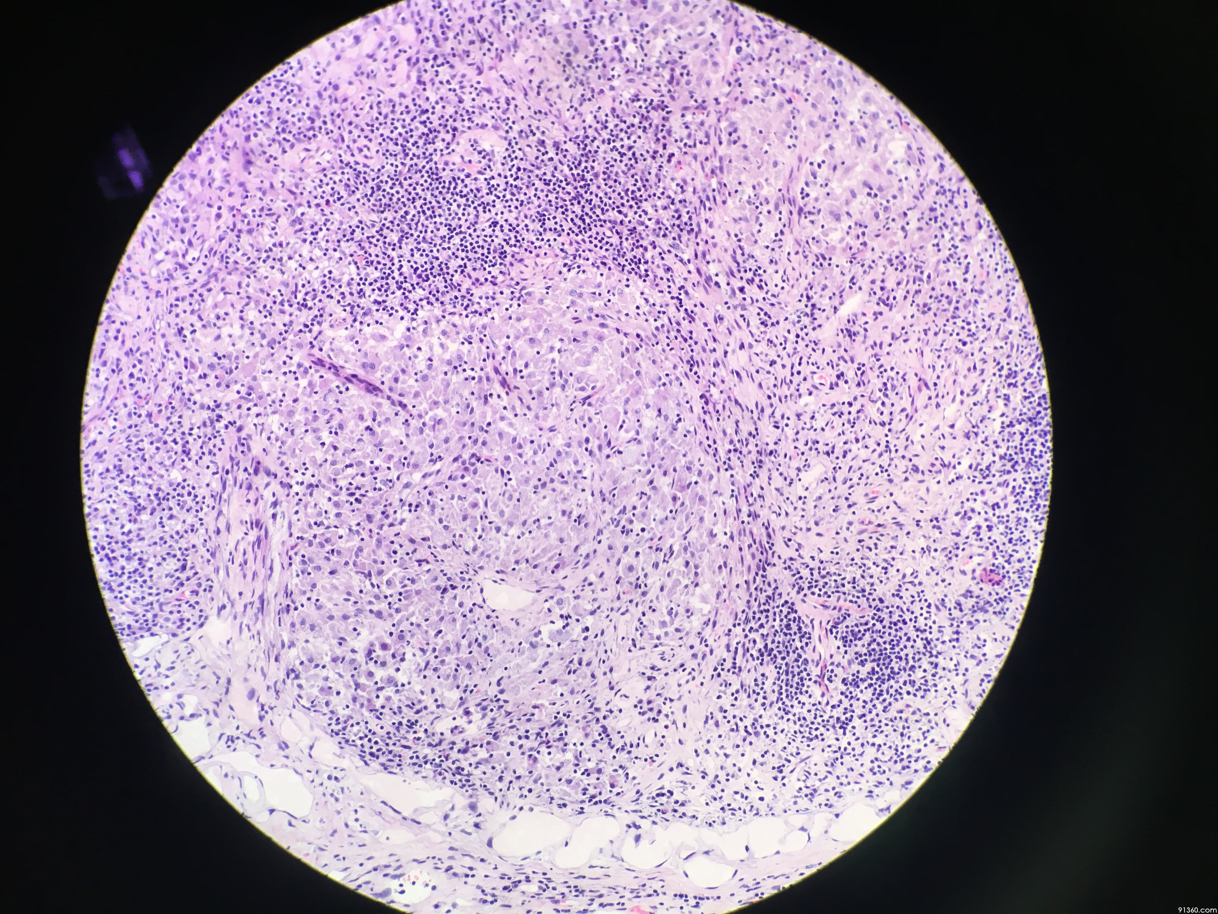 腹膜后淋巴结活检