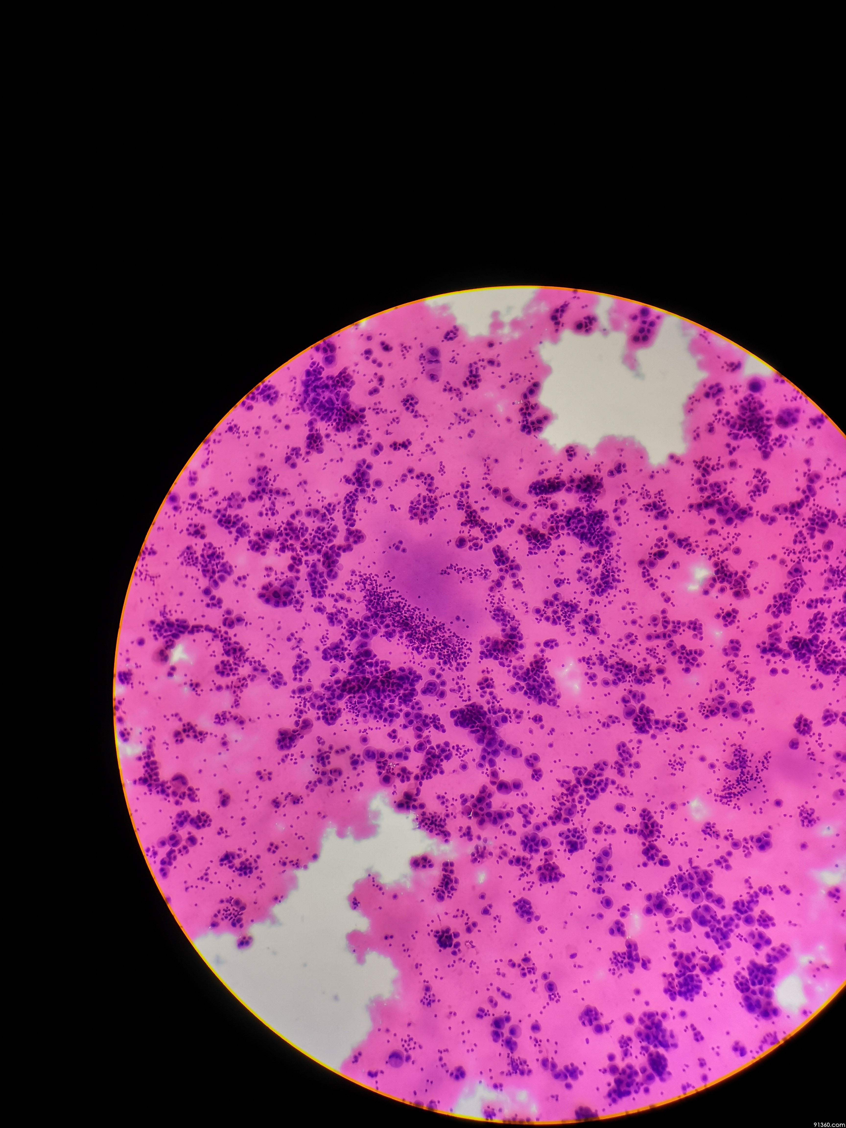 右侧胸水腺癌?讨论2018.09.24【91360细胞病理沙龙病例讨论85】