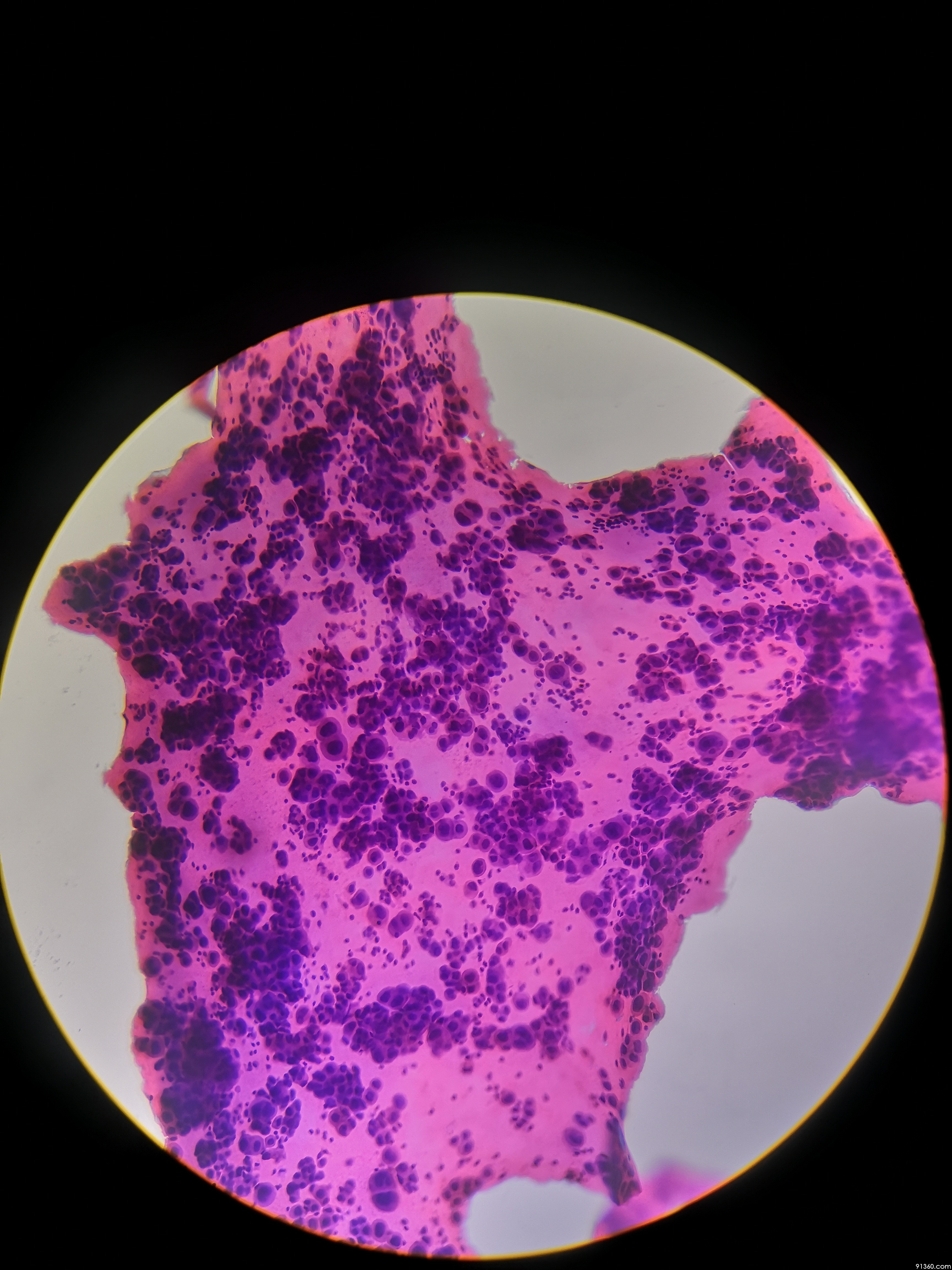 右侧胸水腺癌?讨论2018.09.24【91360细胞病理沙龙病例讨论85】