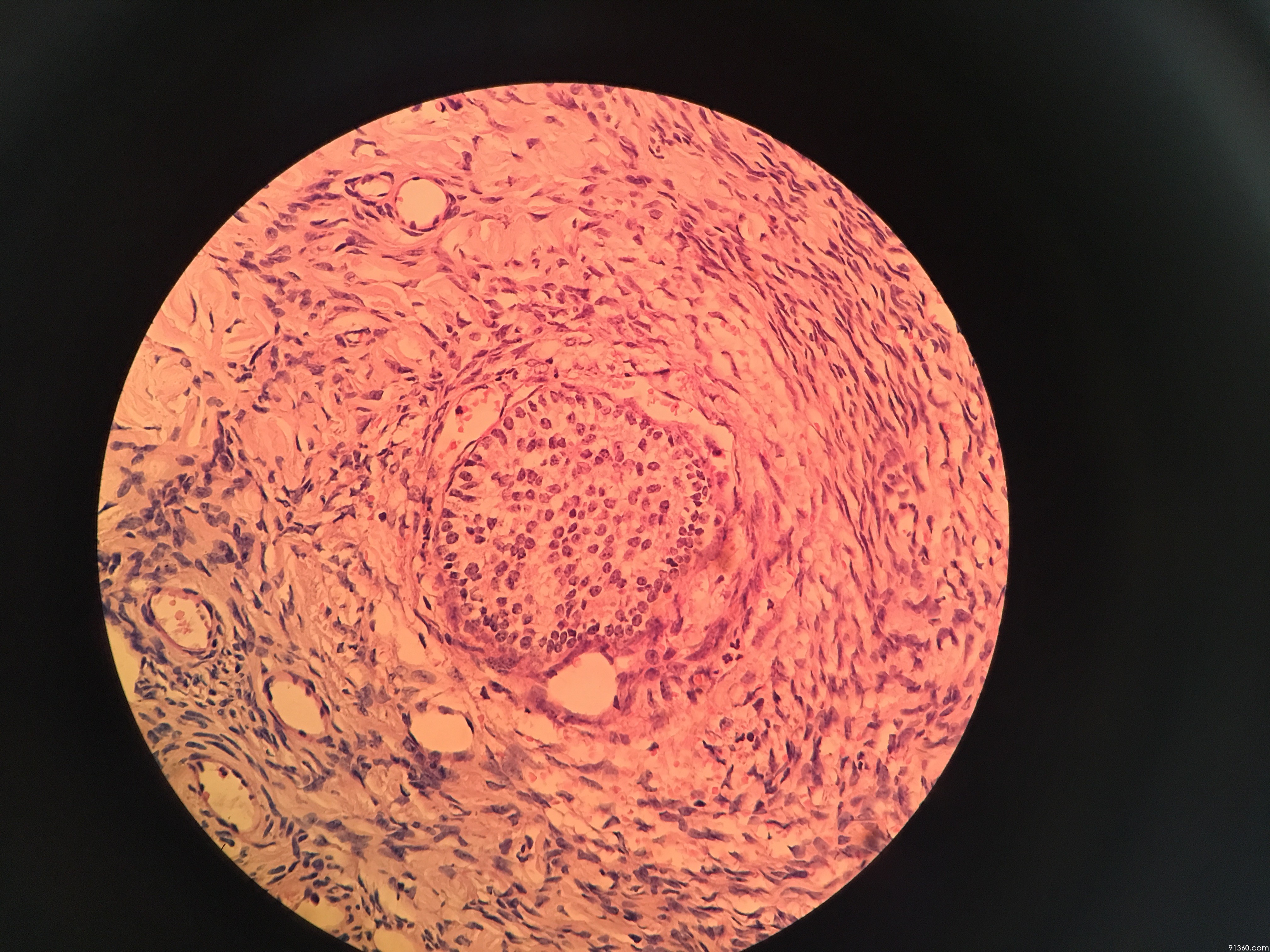 卵巢granulosa cell 颗粒细胞团【中美加卵巢肿瘤病理交流群287】