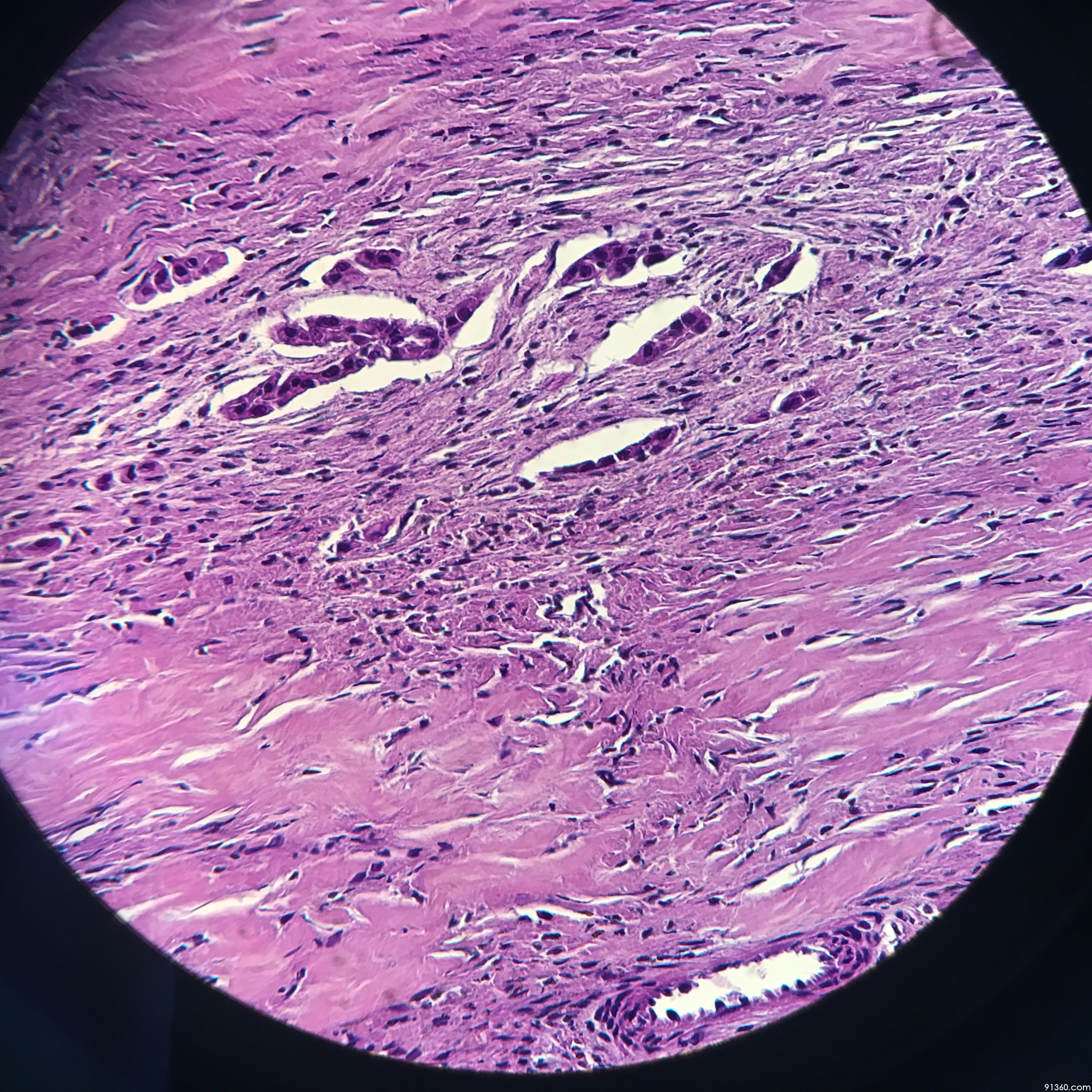 子宫内膜异位?【中美加卵巢肿瘤病理交流群294】