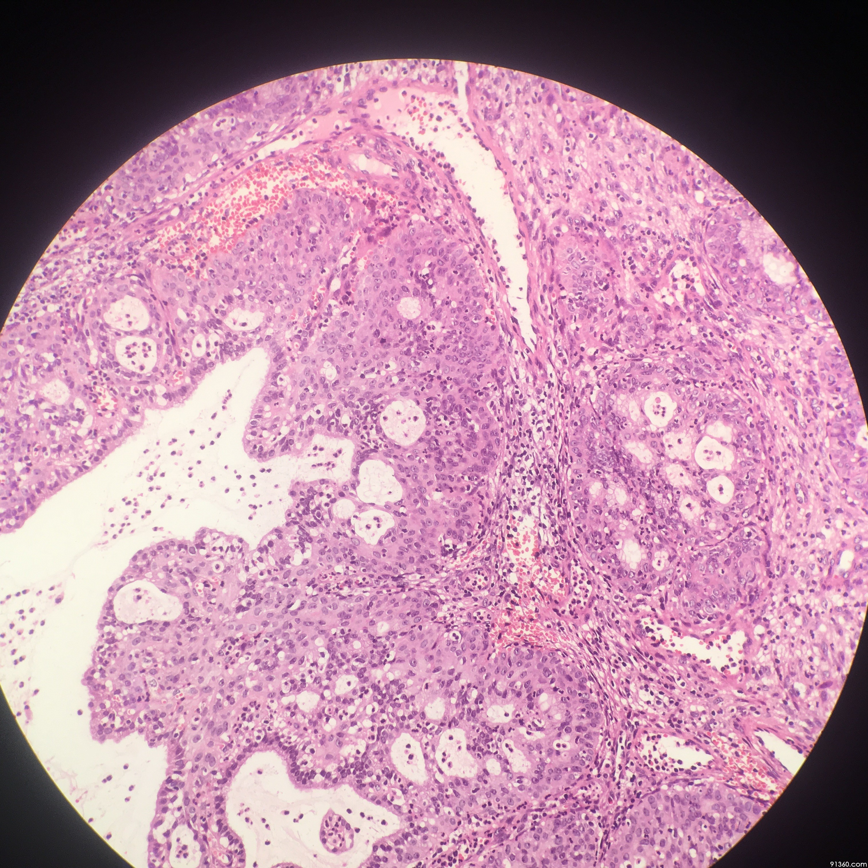 宫颈息肉,伴微腺体增生并鳞化【中美加宫颈病理交流群病例946】