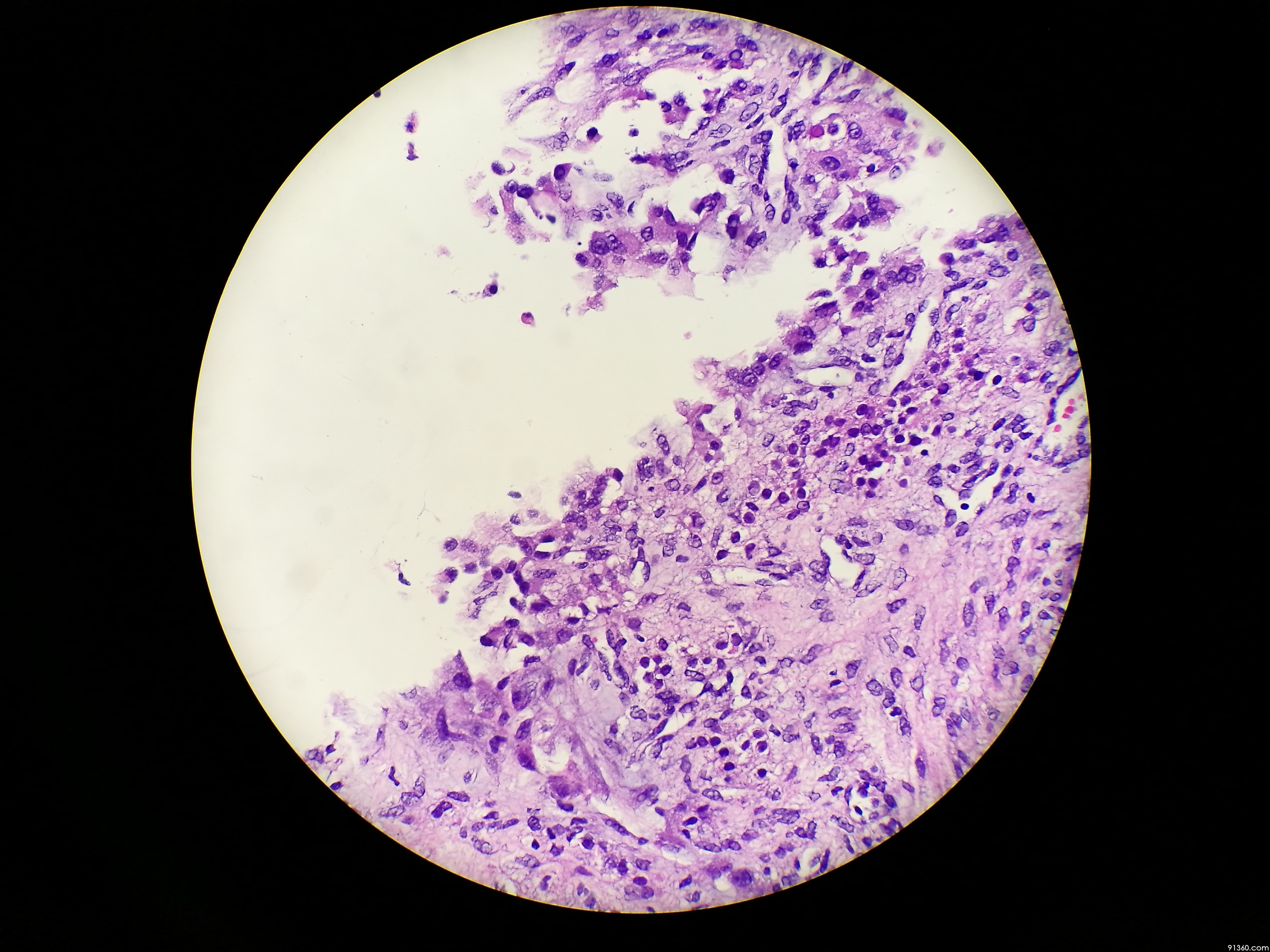 子宫内膜异位症【中美加卵巢肿瘤病理交流群319】