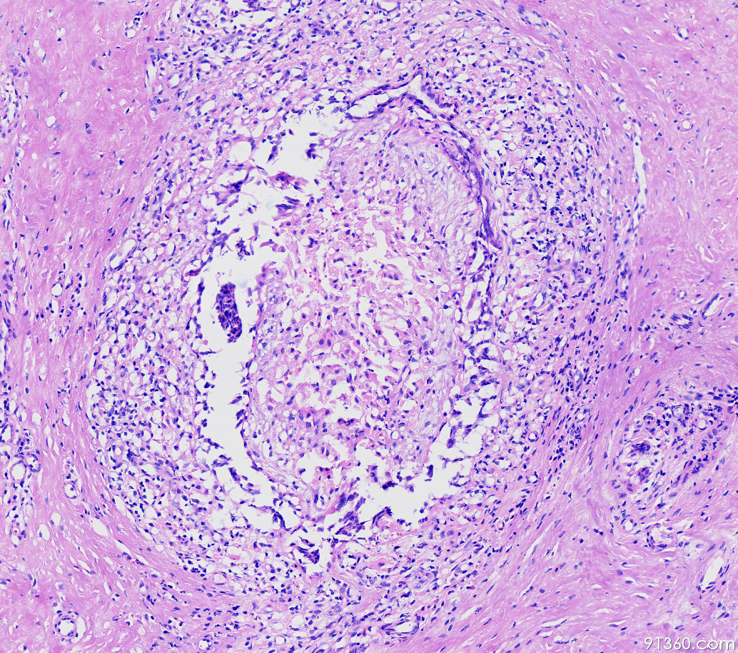浆细胞乳腺炎 病理图片